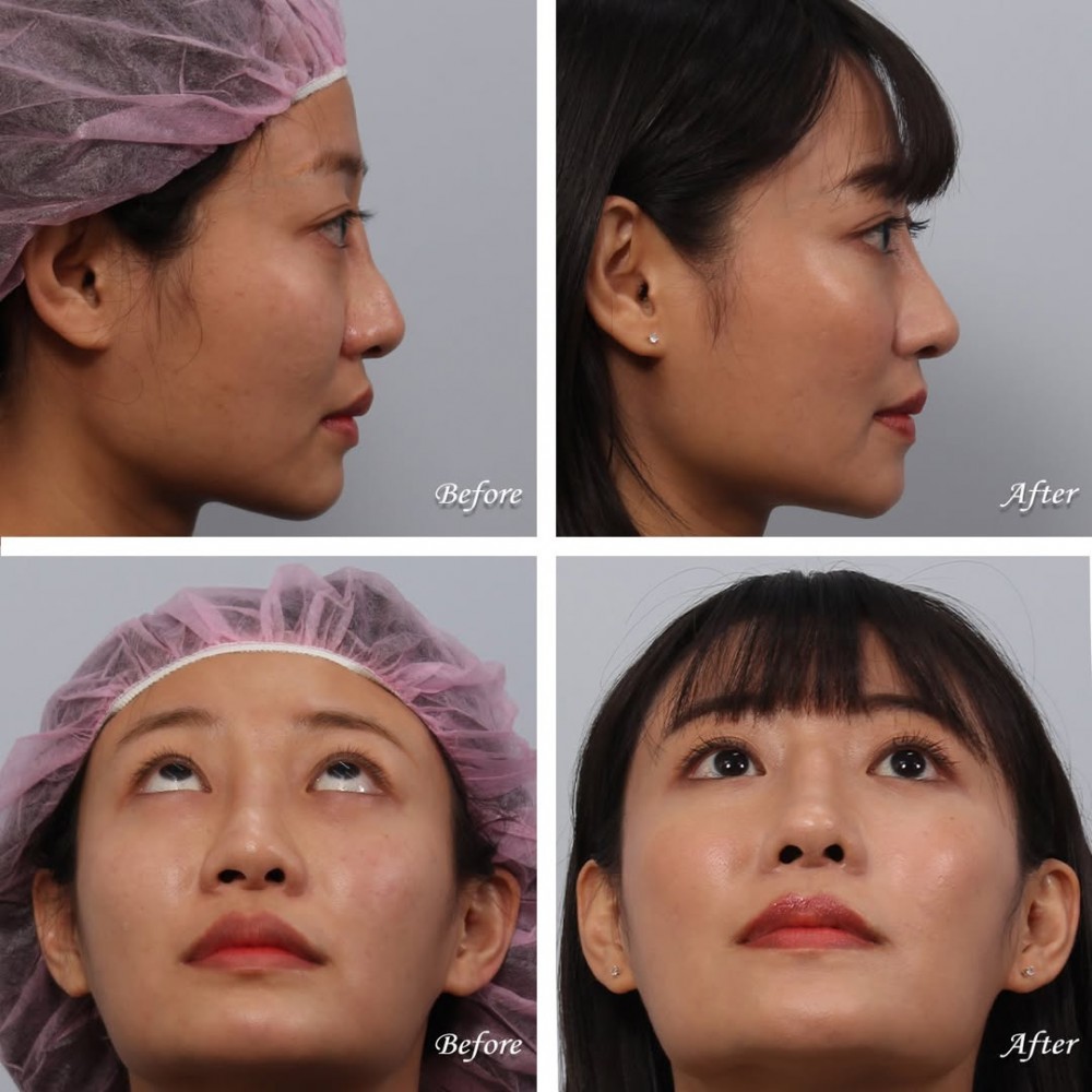 玻尿酸隆鼻植入劑殘留物清除,鼻重修,博恩妍